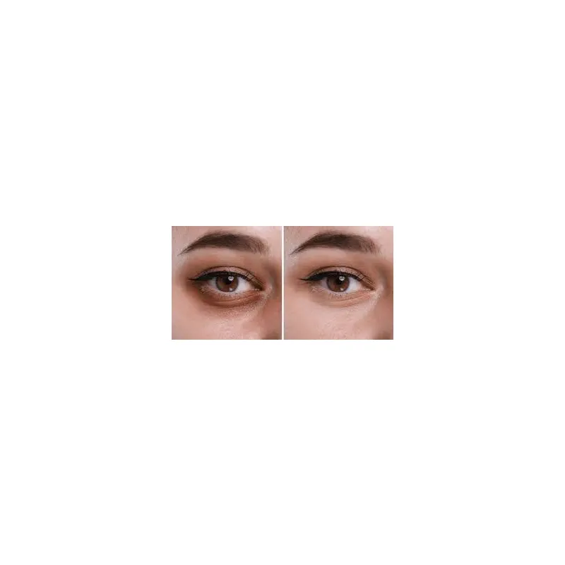 Dark Circles Tratment