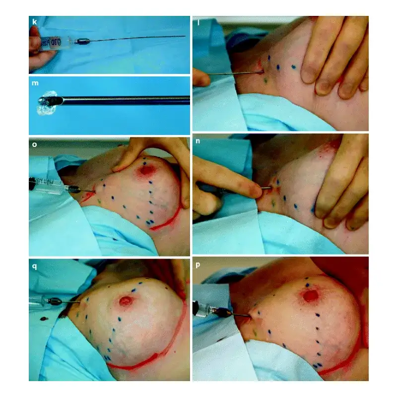 Breast fillers