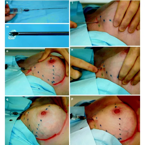 Breast fillers