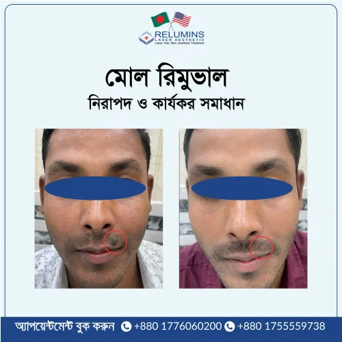 Mole Removal treatment