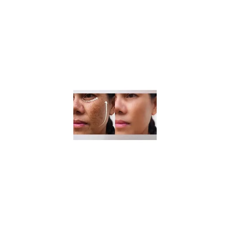Melasma Treatment