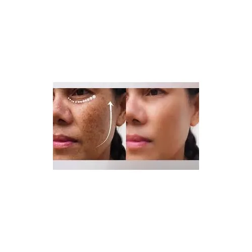 Melasma Treatment
