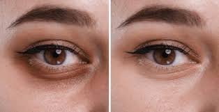 Dark Circles Tratment