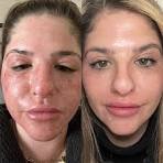 CO₂ Laser Treatment