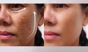 Melasma Treatment